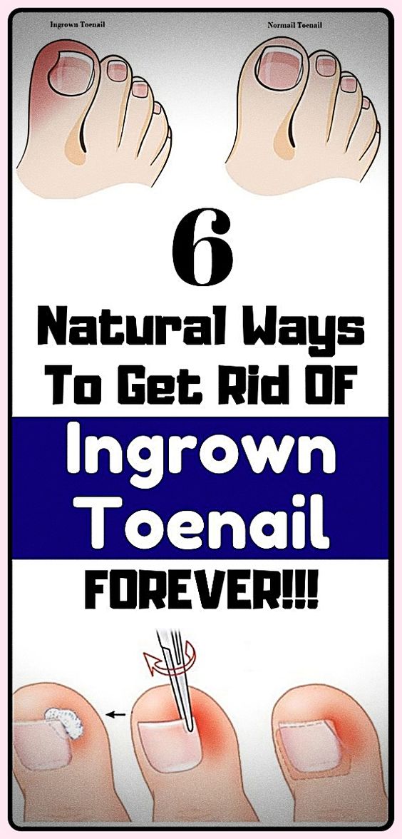 10 Remedies For Ingrown Toenails Wellness Days