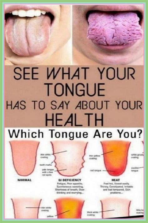 11 Things Your Tongue Can Tell You About Your Health 6 Minute Read In