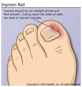 5 Home Remedies For Infected Ingrown Toenails By Top 5 Youtube