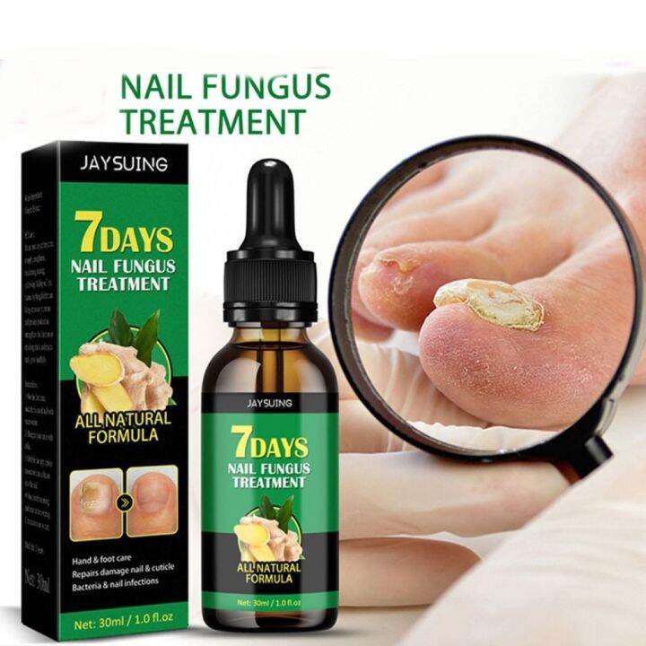 7 Days Ginger Nail Fungal Treatment Feet Care Essence Anti Infection