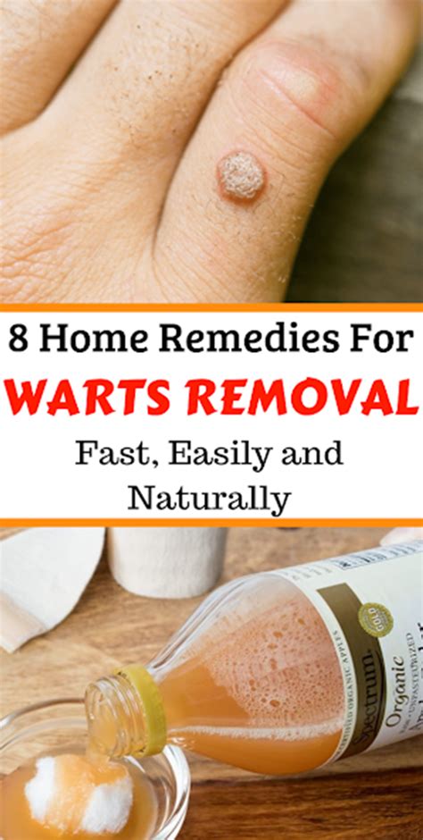 9 Effective Home Remedies For Removing Warts Diy Health Do It