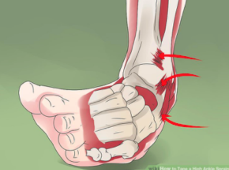 A Sprain A Twist Or A Roll Decipher Your Ankle Injury