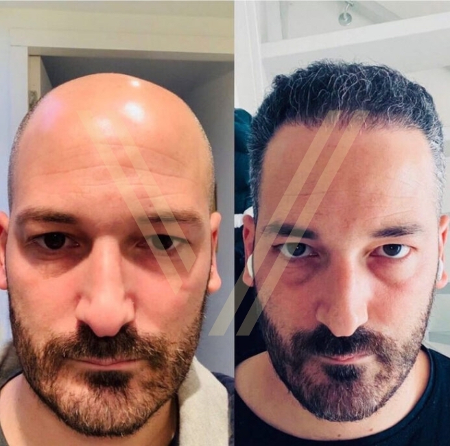 Best Hair Transplant In Turkey Istanbul At Best 2024 Price