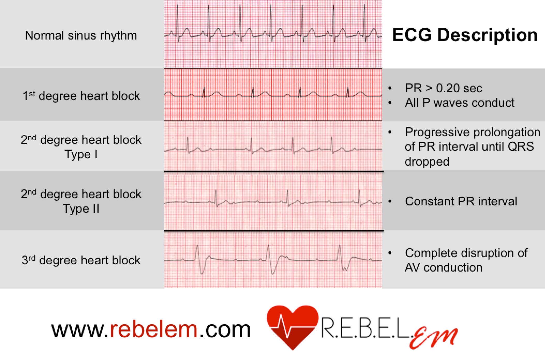 Bradycardia Ecgs Explained Emergency Medicine Kenya Foundation