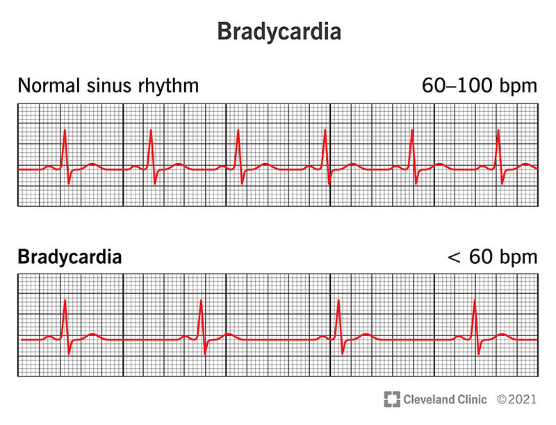 Bradycardia Symptoms Causes Treatment