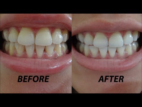 Crest 3D White Whitestrips Before After 3Dwhitesmile Youtube