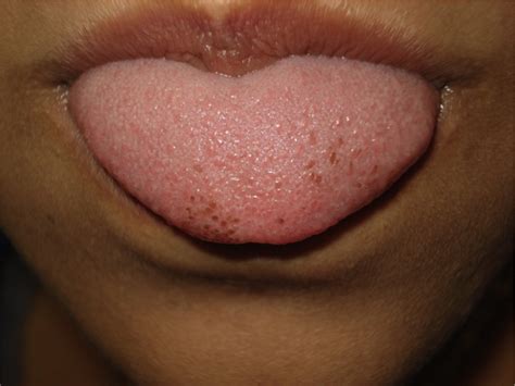 Dark Spots On The Tongue Journal Of The Dermatology Nurses Association