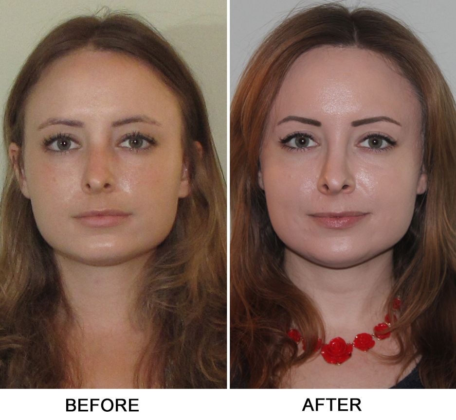 Deviated Septum Nose Job Before And After Katherin Freed