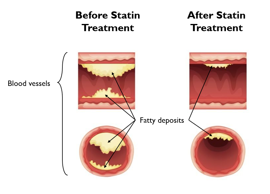 Do Statins Lower My Chances Of Blood Pressure Related Problems Like Heart Disease And Stroke Pals