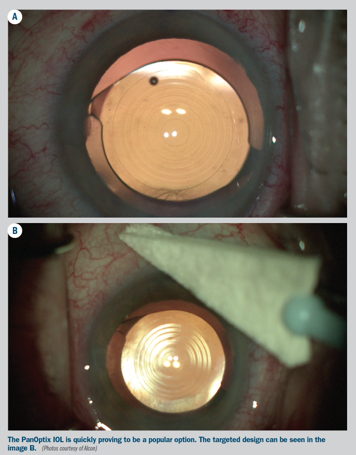 Dr Carlos Buznego Implants New Trifocal Iol Alcon Panoptix Available