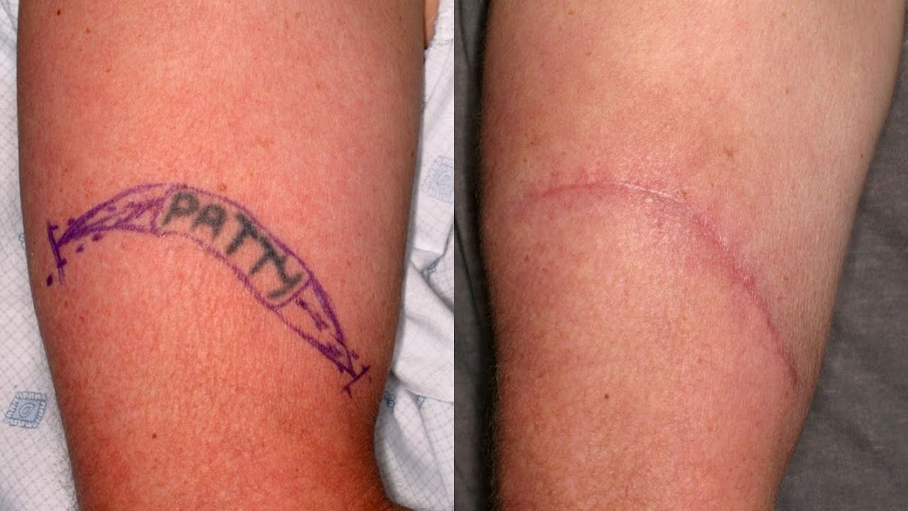 Everything You Need To Know About Tattoo Removal Youtube