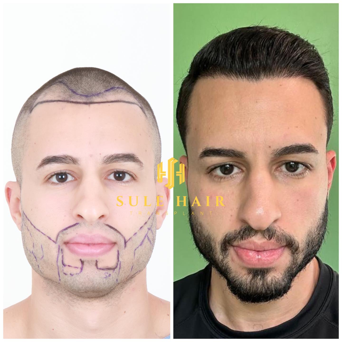 Hair Transplant Turkey Before And After Photos Sule Clinic