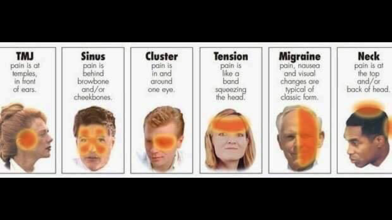 Headache Chart What Does Headache Location Mean