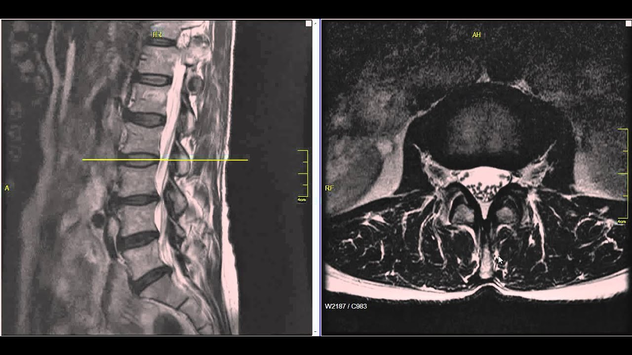 How To Heal Your Disc Herniation Without Surgery Youtube