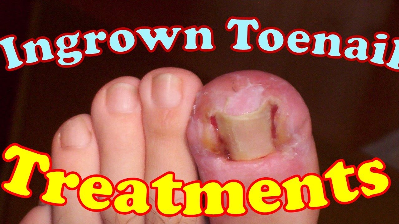 How To Treat An Ingrown Toenail With Epsom Salt Youtube