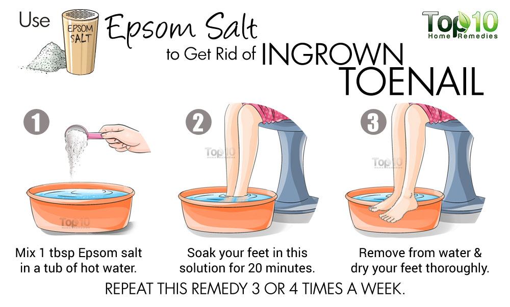 How To Treat Ingrown Toenail At Home Without Effort Fitneass