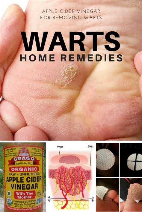 How To Use Apple Cider Vinegar To Remove Warts Apple Cider Vinegar