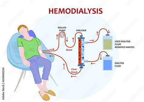 Does Dialysis Damage Your Heart - Coe Psu