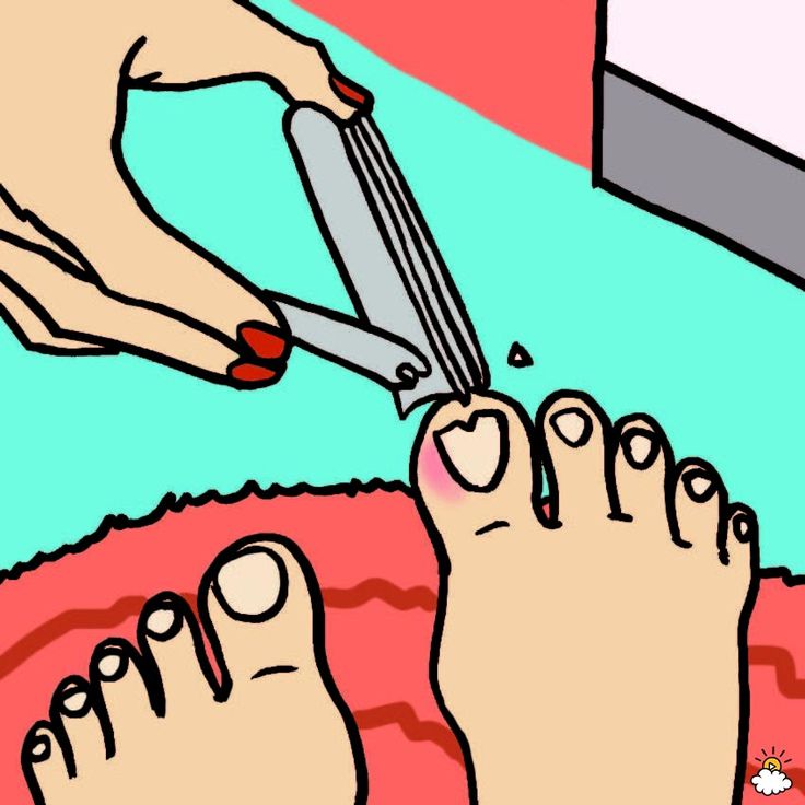 Ingrown Toenail Epsom Salt