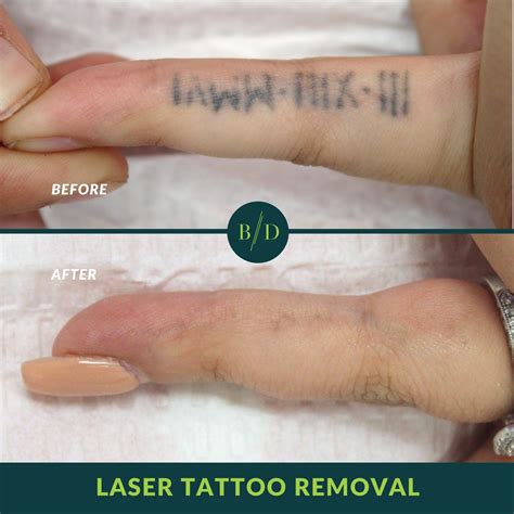 Laser Tattoo Removal Before And After Hand Best Tattoo Ideas