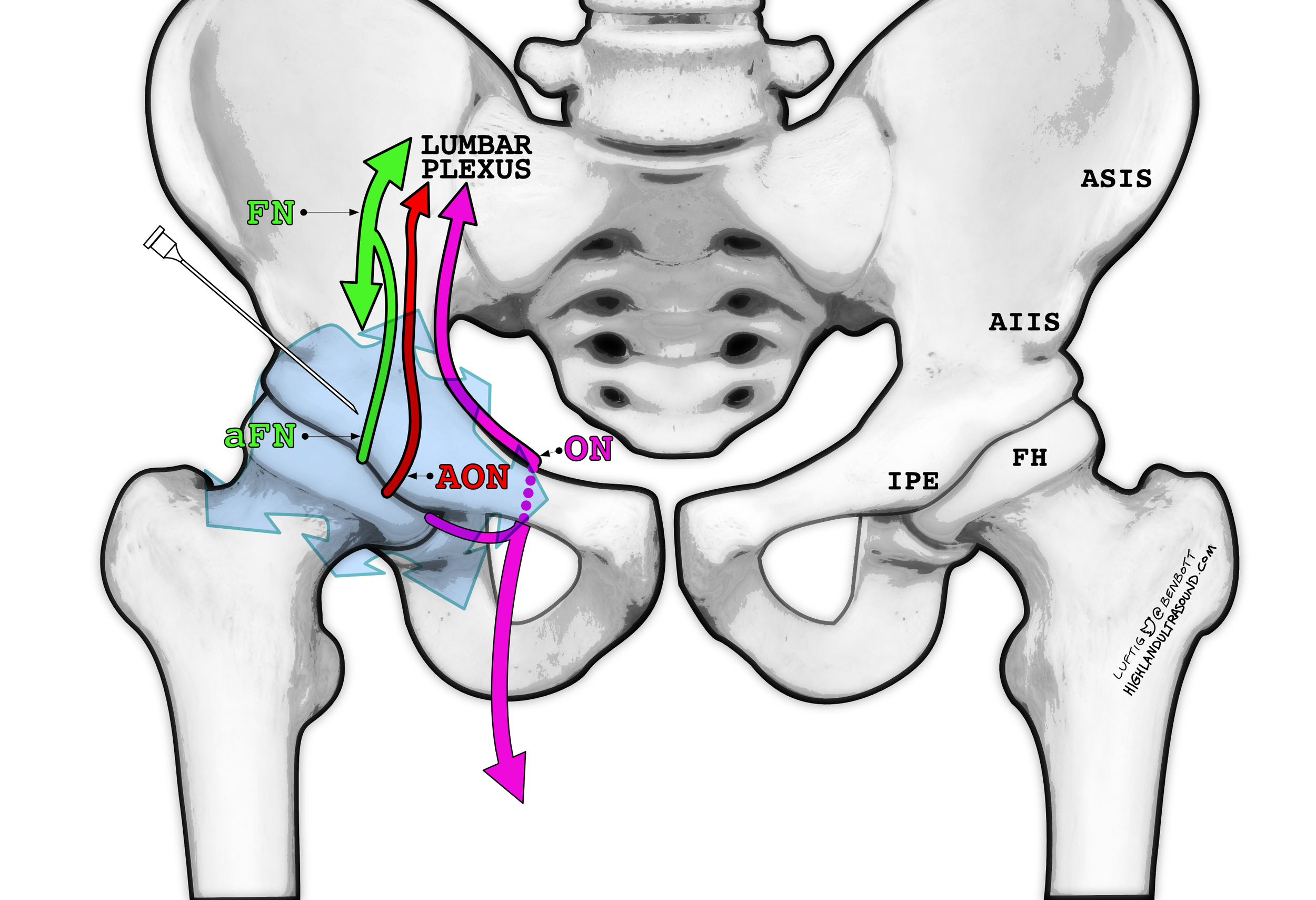 Lumbar Puncture Highland Em Ultrasound Fueled Pain Management