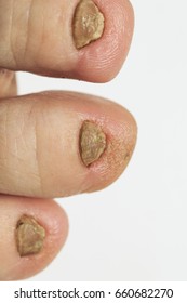 Nasty Nails On The Foot A Fungal Disease Large Stock Image Image Of