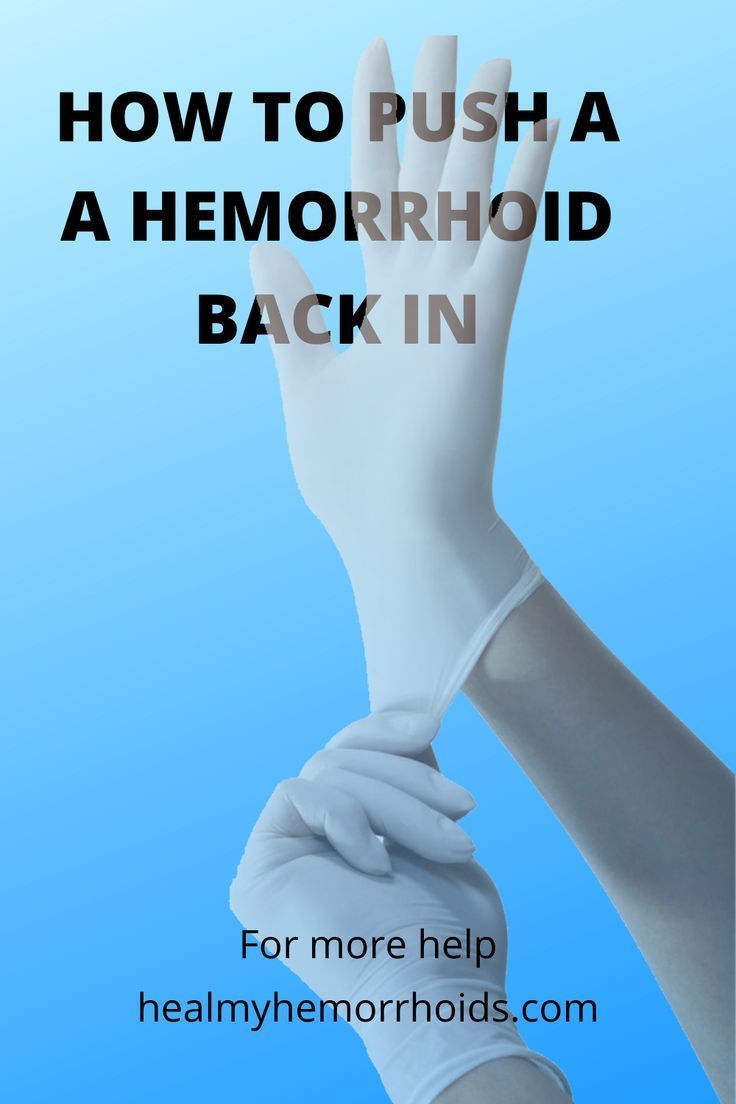 Pin On How To Treat External Hemorrhoids