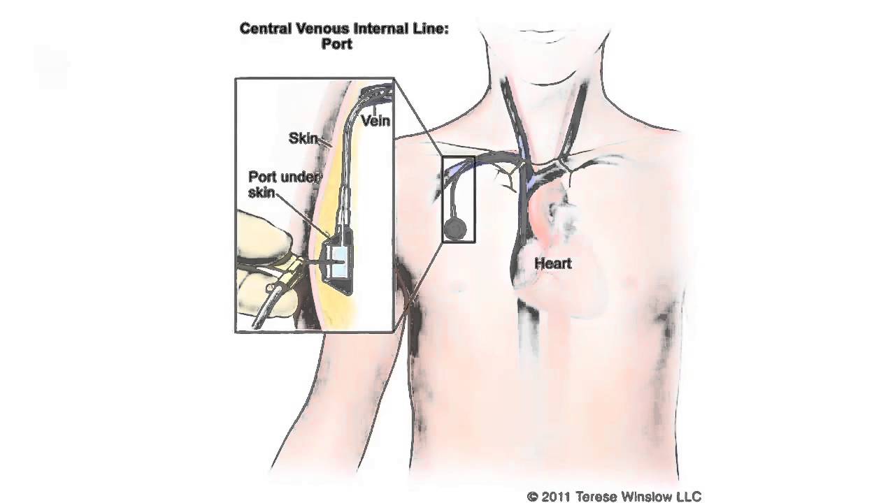 Port A Cath Removal Time Youtube