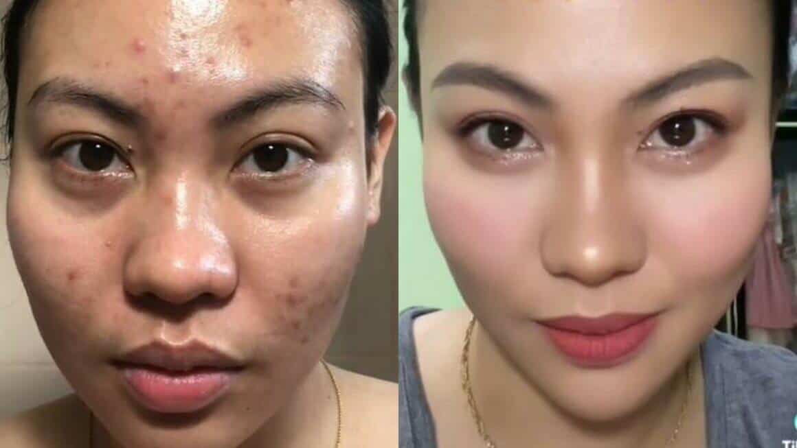 Retin A Before And After Pores