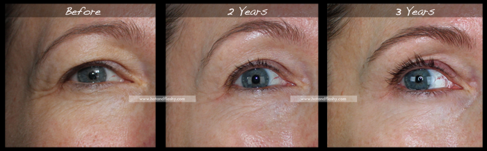 Retin A For Wrinkles 3 Year Results Before After Hotandflashy