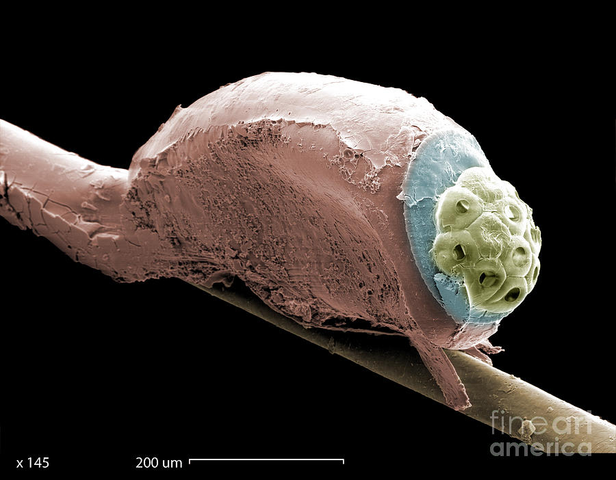 Sem Of A Head Lice Eggs By Ted Kinsman