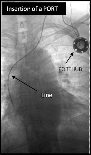 Swslhd Medical Imaging Insertion Of A Portacath