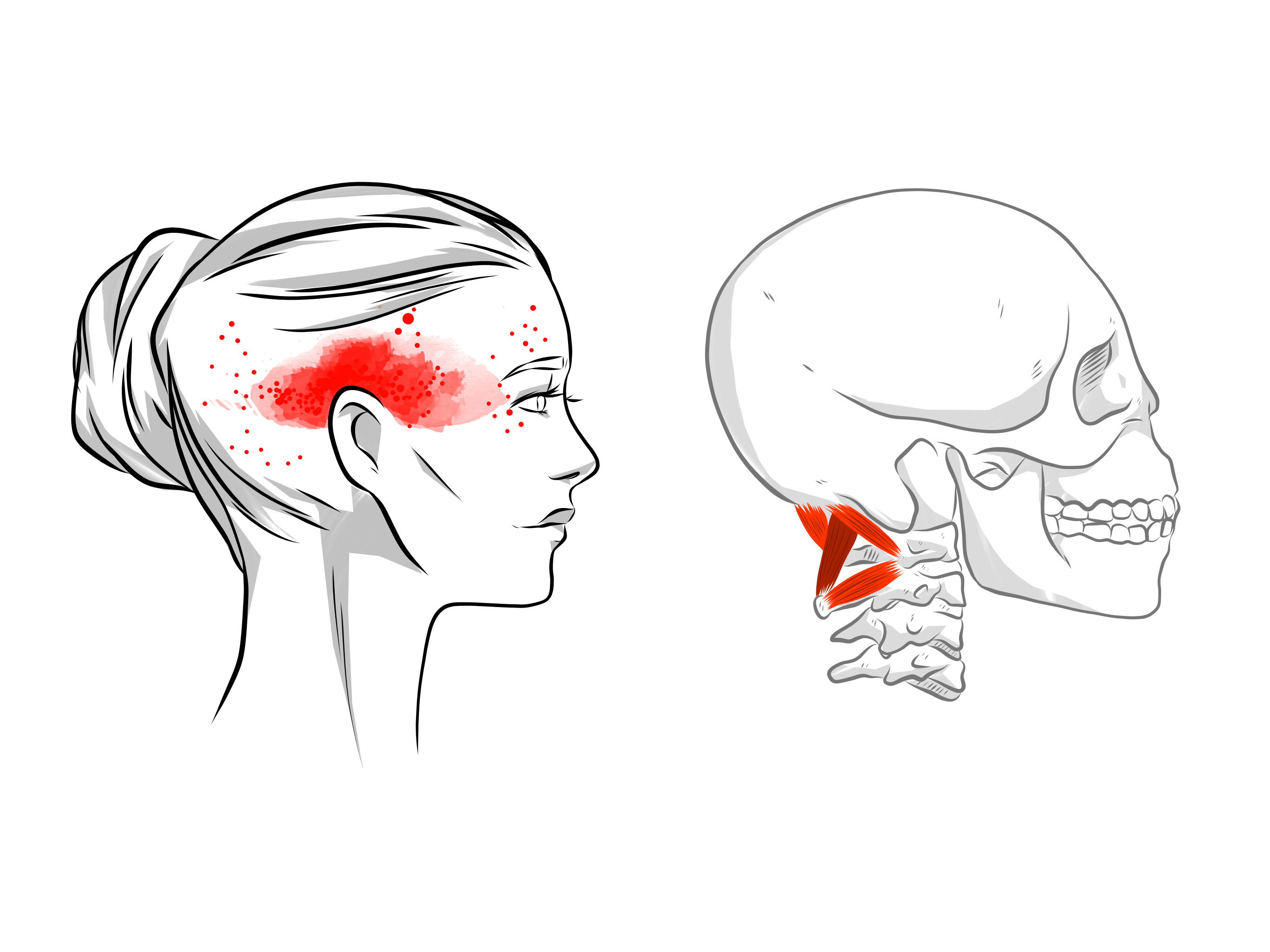 The Overlooked Cause Of Headaches And Migraines