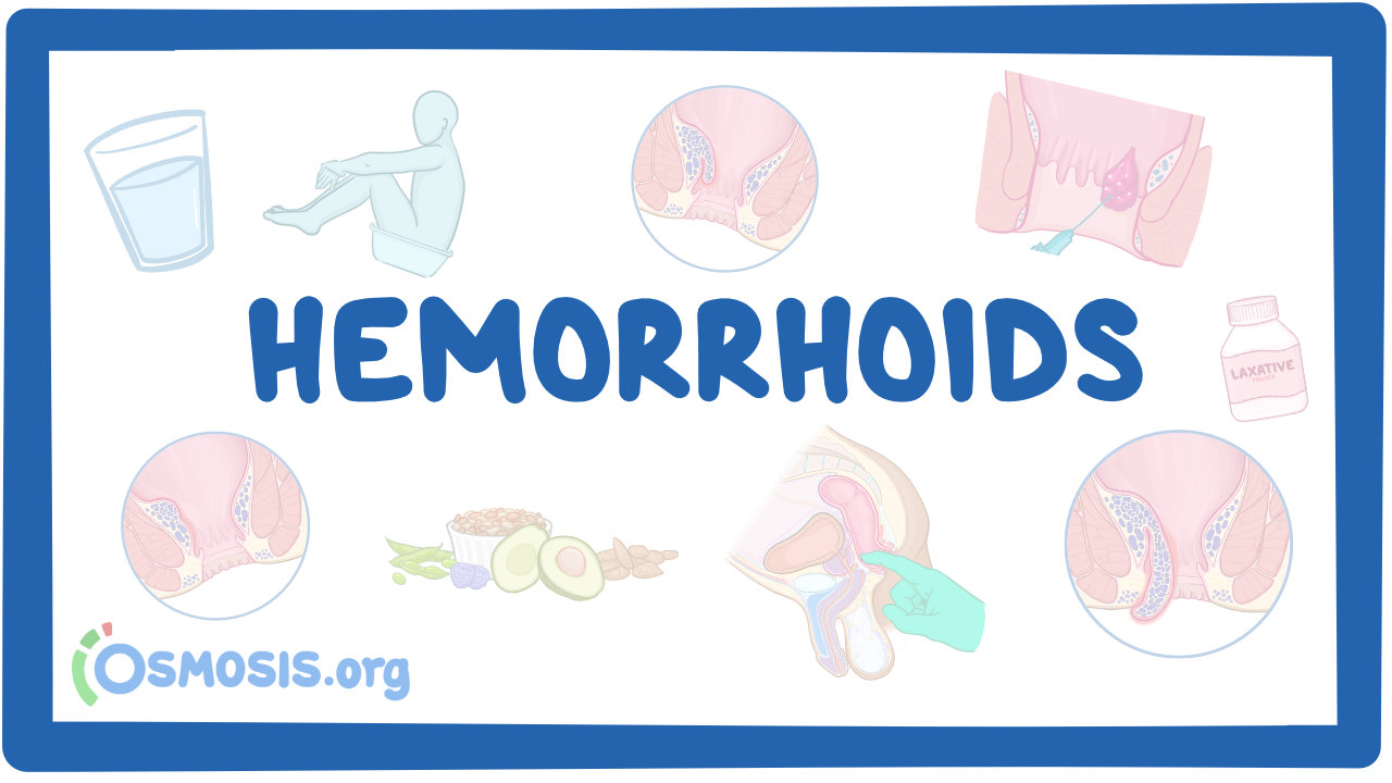 Thrombosed Hemorrhoid Symptoms Causes Diagnosis