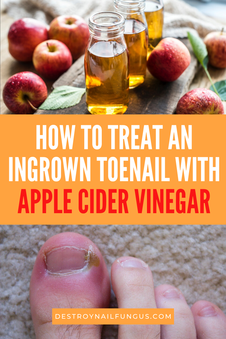 Tips For Expertly Treating Ingrown Toenail Apple Cider Vinegar Soak