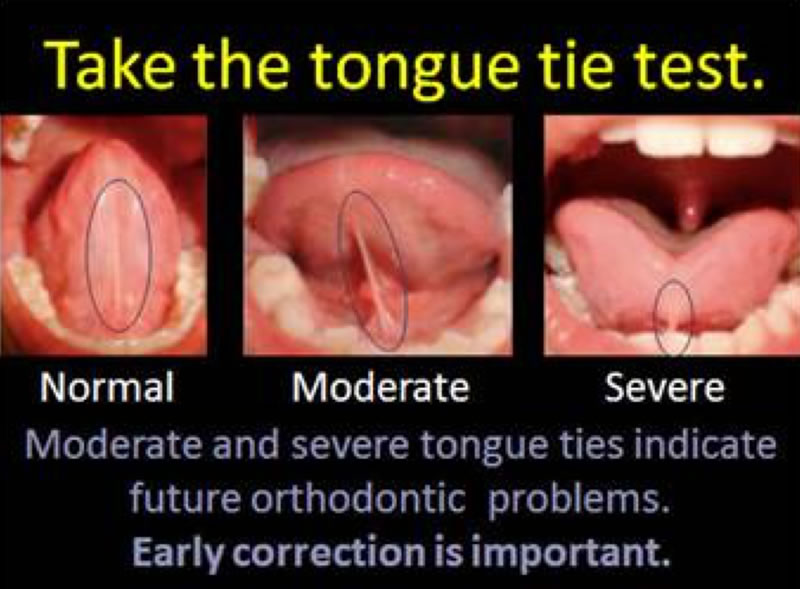 Tongue Tie In Adults Treatment Options Healthnews