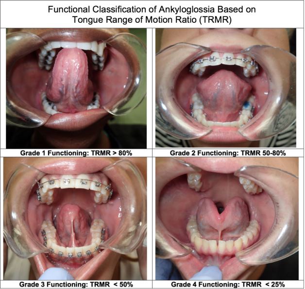 Tongue Tie Tips Alabama Tongue Tie Center Dr Richard Baxter