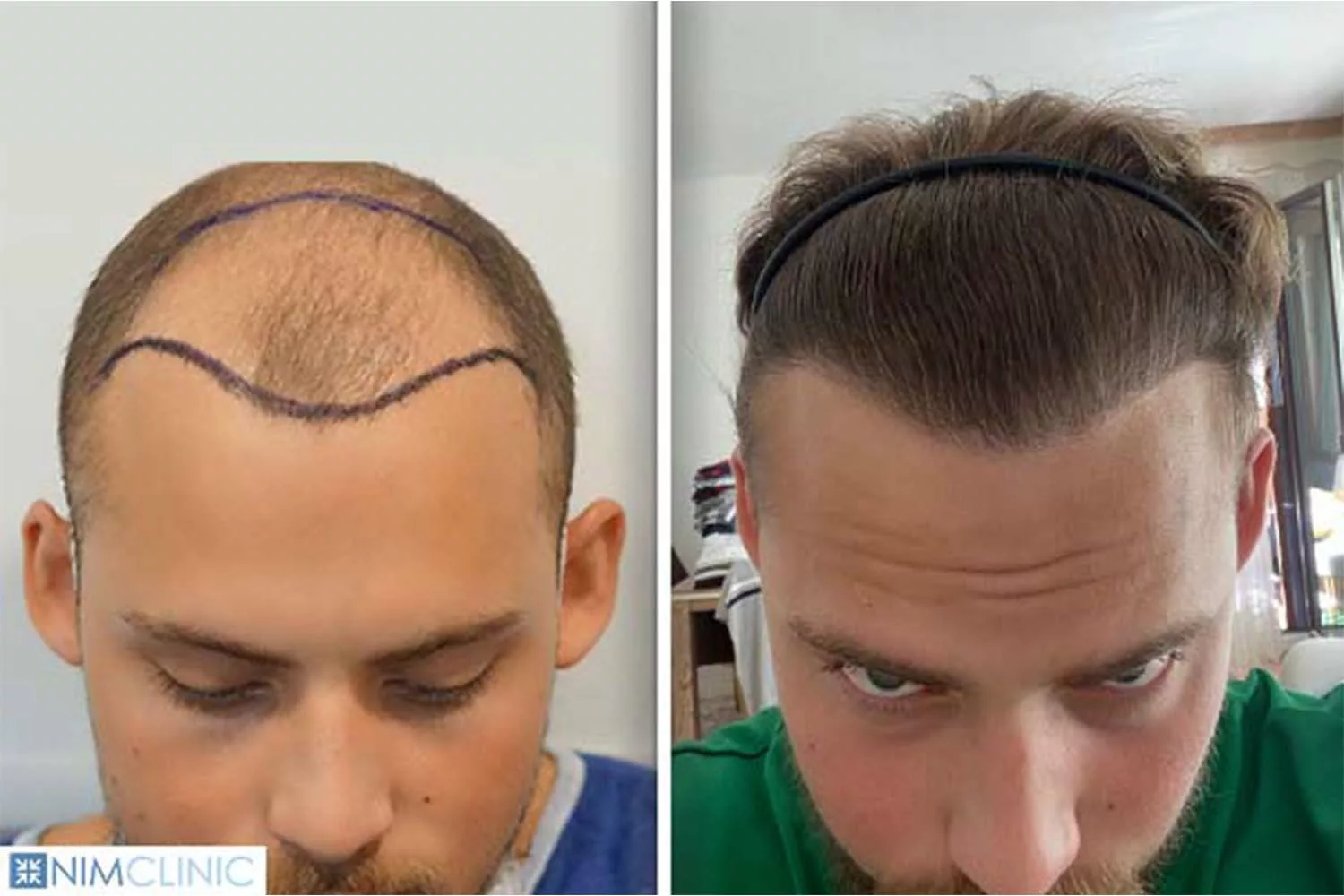 Top 20 Best Hair Transplants In Turkey And Cost In 2023