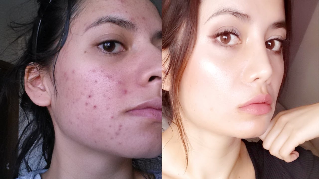 Tretinoin Cream Before And After