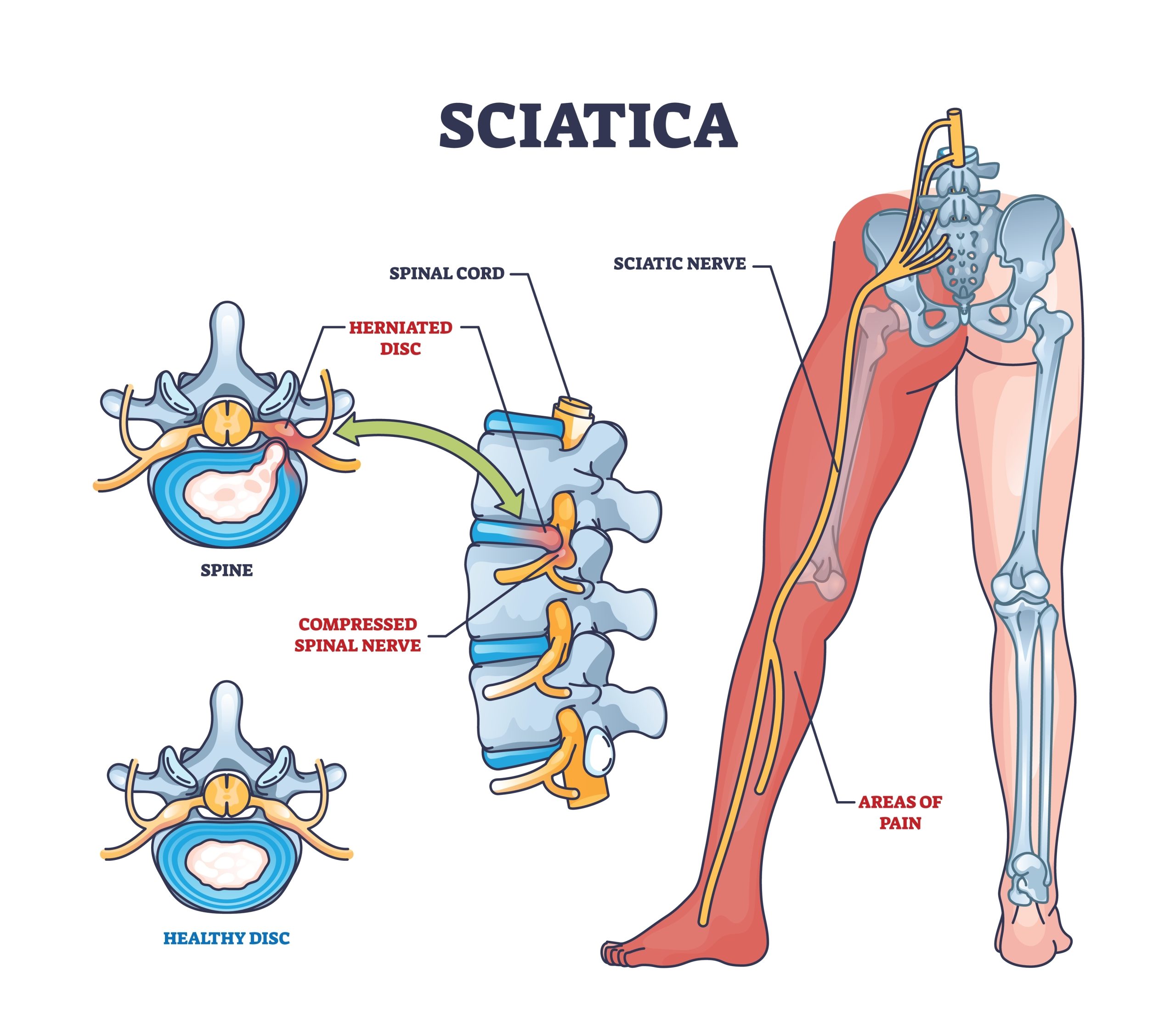 Unlock The Benefits Of Vitamins For Sciatica Relief