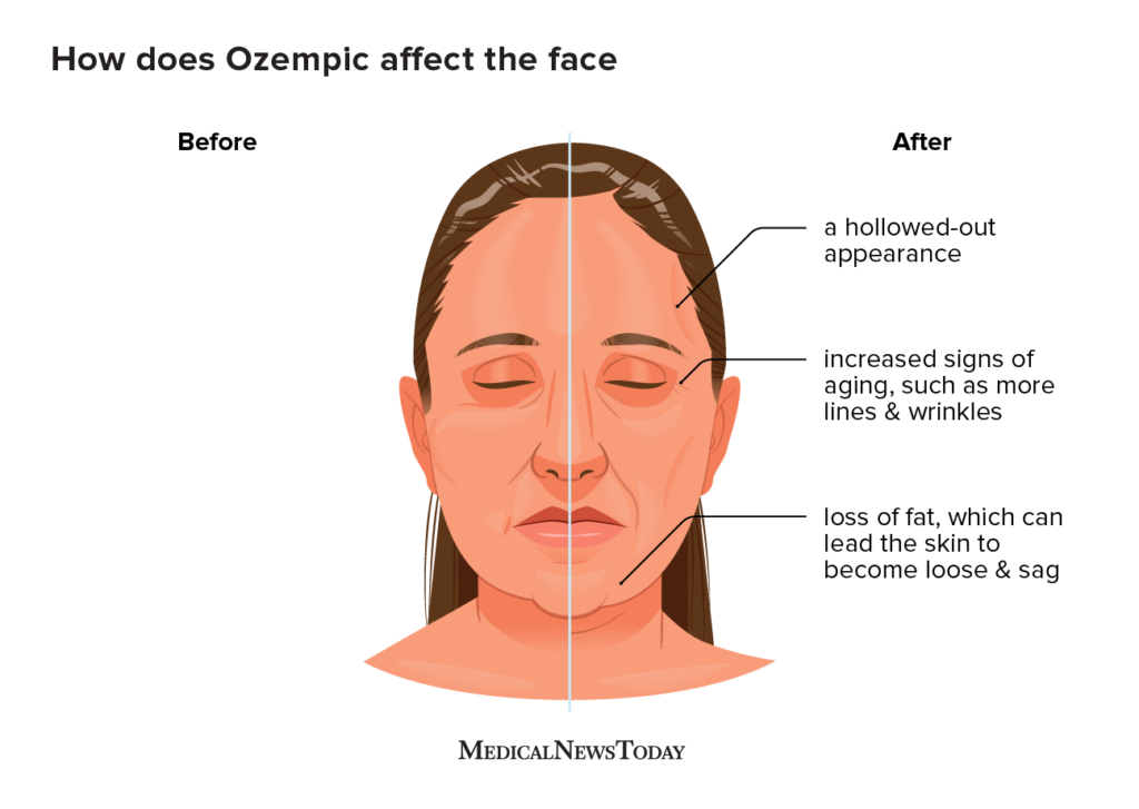 Unraveling The Safety And Potential Side Effects Of Ozempic And Zepbound