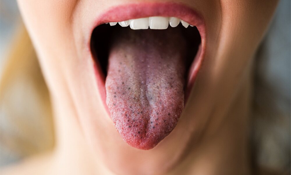 What Are Those Black Spots On Your Tongue