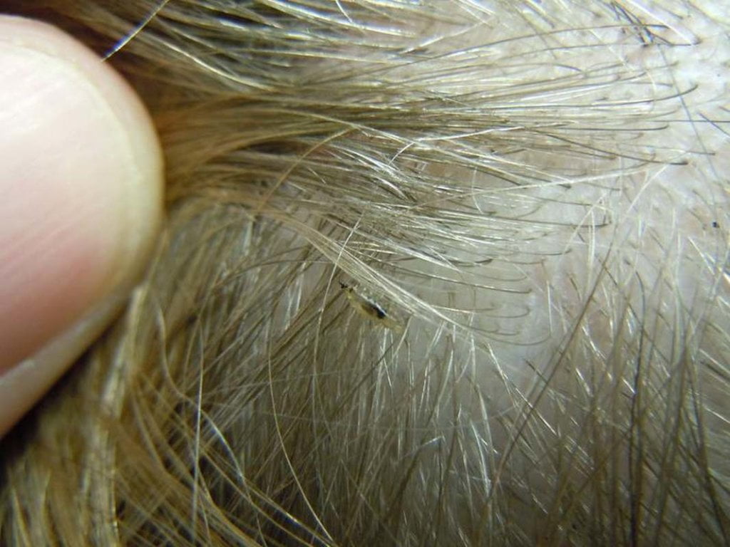 What Does Lice Look Like Pictures Of Nits Eggs Lice